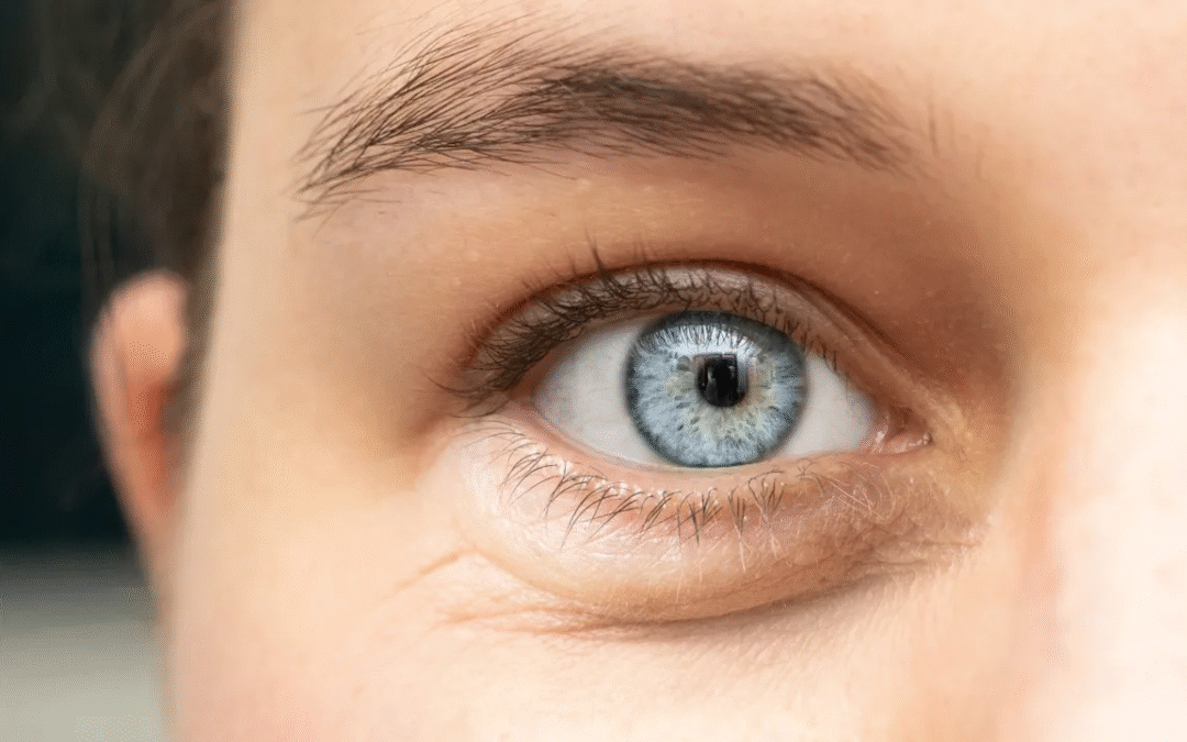 Elimina las bolsas bajo los ojos con la blefaroplastia láser en Bogotá