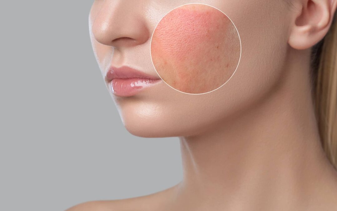 Tratamiento de Manchas y Rosácea con IPL