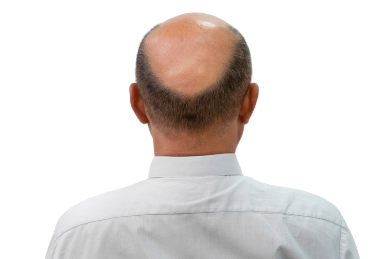 Caida_cabello_004