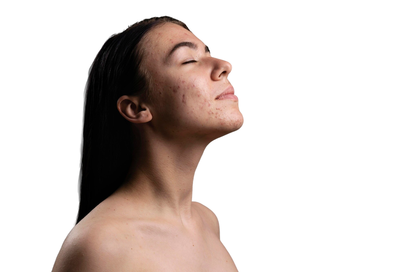 Tratamiento_acne_004