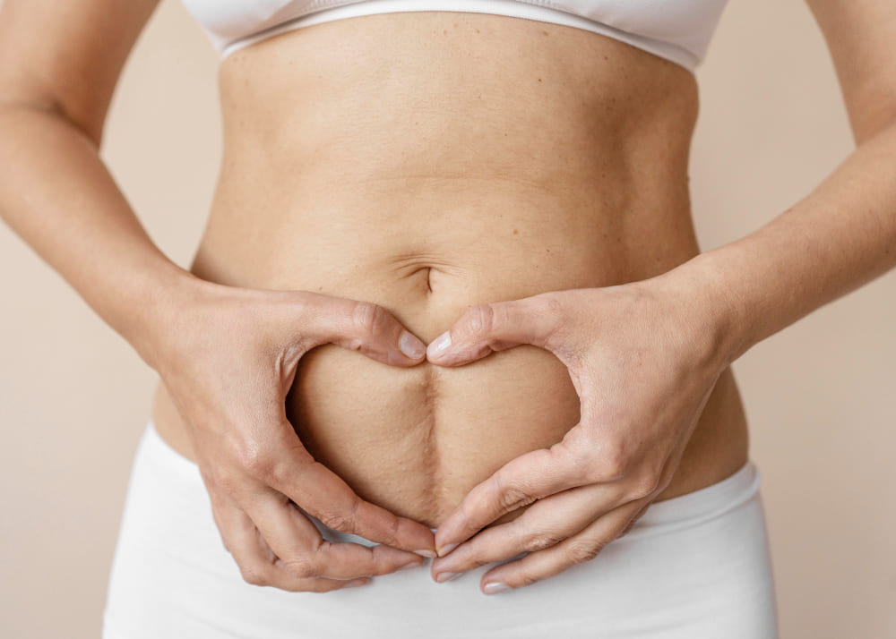 Hilos Tensores en Abdomen