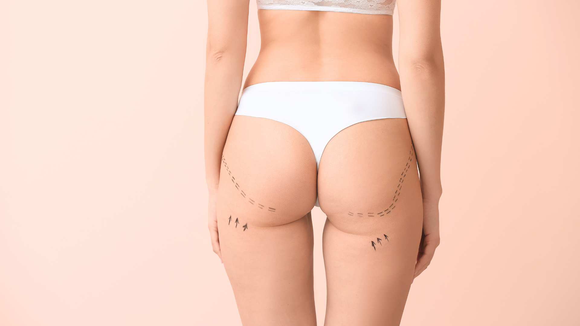 hilos tensores en glúteos