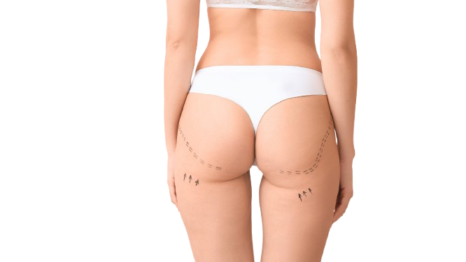 hilos tensores en glúteos en bogota